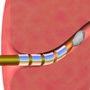 Fallopian Tube Implant