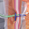 GERD Repair