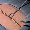 Skin Incision